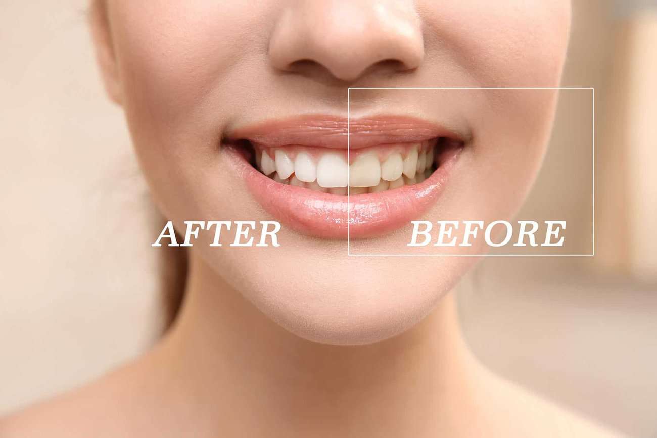 What Are the Most Effective Natural Teeth Whitening Methods You Can Try Waterlooville?