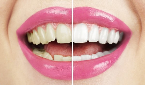 What Makes Ultima White Teeth Whitening Different Waterlooville
