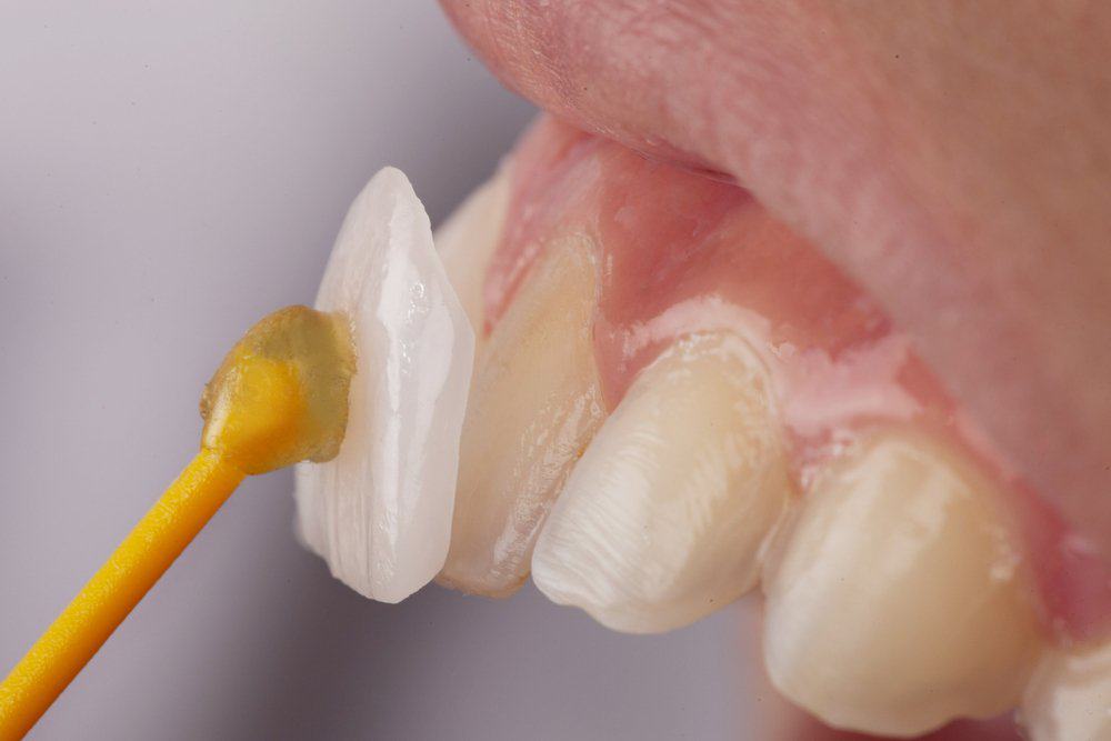 Why Do Dental Crowns Fail or Get Damaged Prematurely Waterlooville?