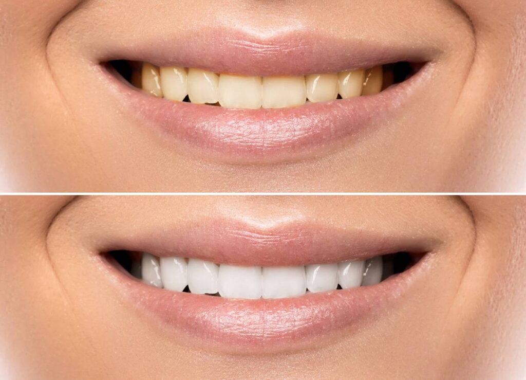 How Can You Protect Your White Smile as a Coffee Lover Waterlooville?