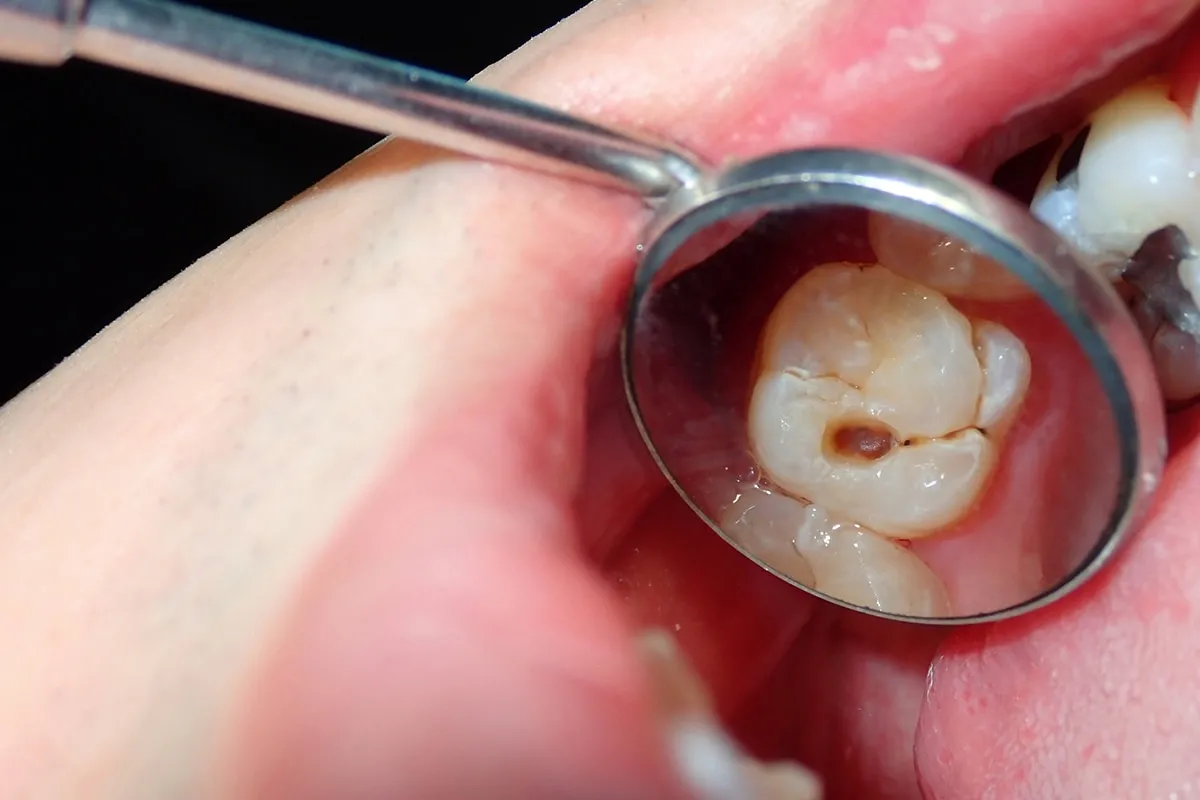 Why Do Teeth Crack? Common Causes to Know Waterlooville