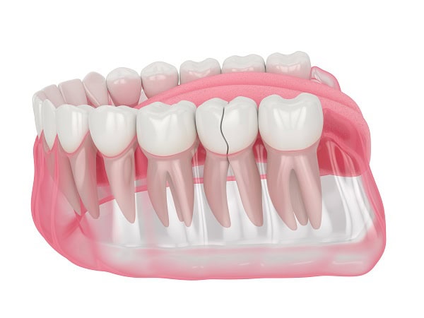 How Can You Manage Pain and Discomfort After a Root Canal Waterlooville?