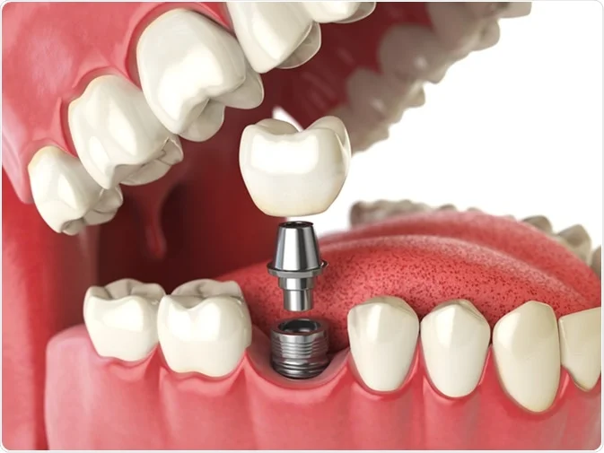 How Do I Decide Which Tooth Replacement Is Right for Me Waterlooville?