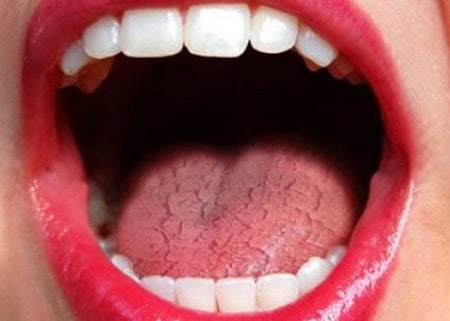 Common Causes of Dry Mouth (Xerostomia) Waterlooville