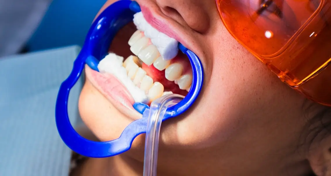 What Side Effects Can You Experience After Laser Teeth Whitening Waterlooville?