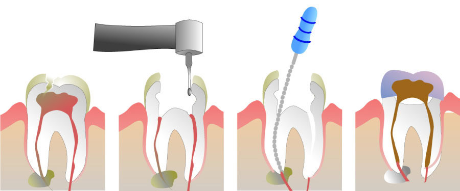 How Do You Properly Care for Your Teeth After a Root Canal Waterlooville