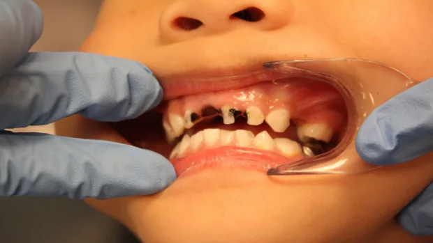Tips for Keeping Your Child’s Baby Teeth Healthy and Strong Waterlooville