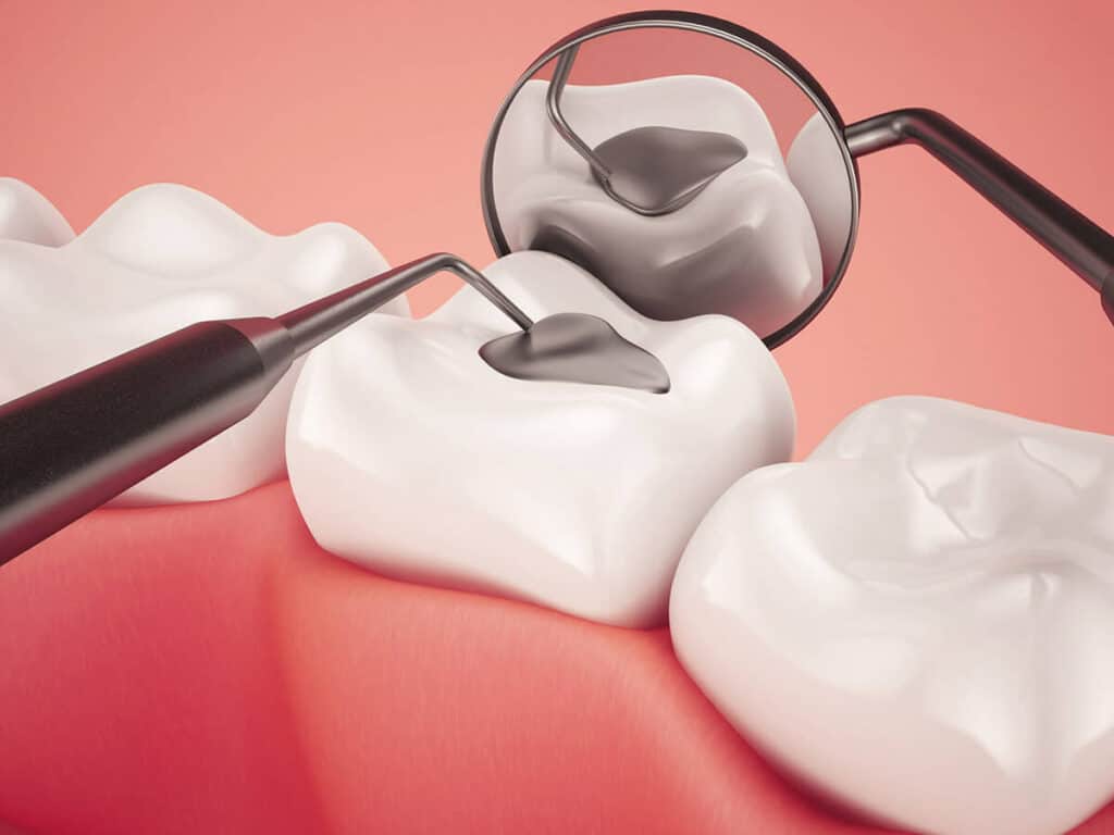 How Can You Prevent Tooth Decay Effectively Waterlooville