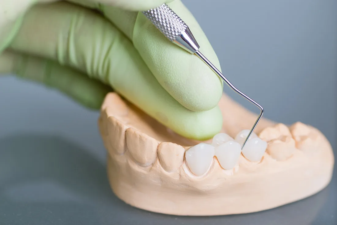 Do Braces Take Years to Show Results Waterlooville