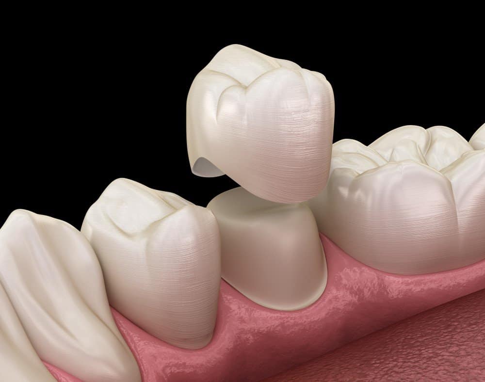 How Can You Prevent Common Dental Crown Problems Waterlooville?