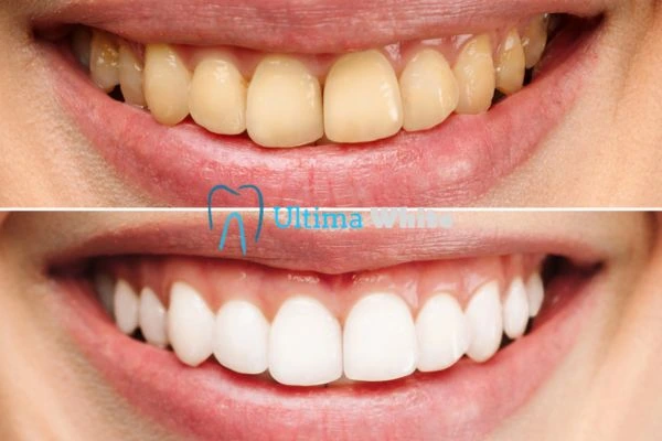 Why Might Multiple Whitening Sessions Be Necessary Waterlooville?