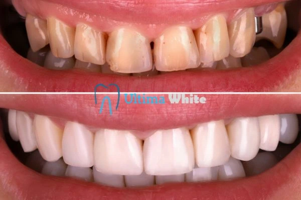What Makes Instant Teeth Whitening Treatments So Popular Waterlooville?