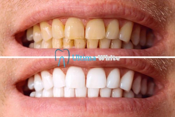 Stained Teeth and Persistent Bad Breath Waterlooville
