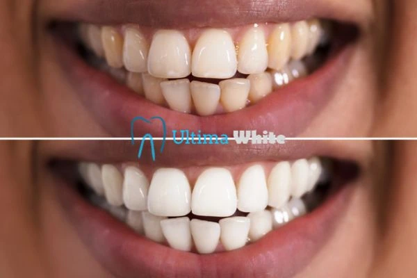 Aftercare Tips to Maintain Your New Smile Waterlooville